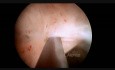 Asherman's Syndrome