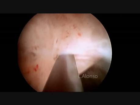 Asherman's Syndrome