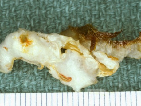 Keratosis Obturans [Keratin Plug]