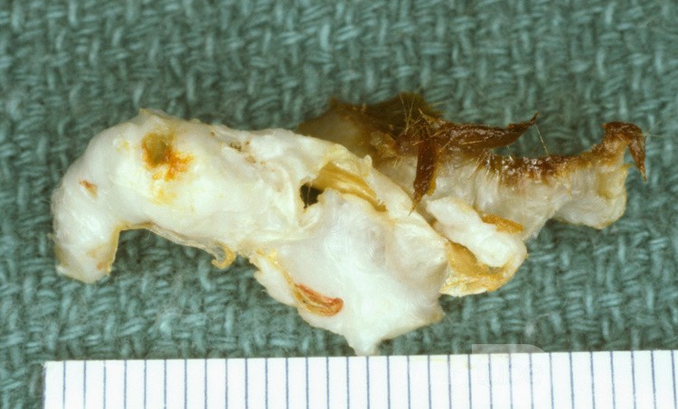 Keratosis Obturans [Keratin Plug]