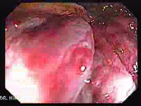 Internal Hemorrhoids (4 of 5)