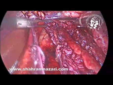 Coexisting Achalasia and Large Hiatal Hernia