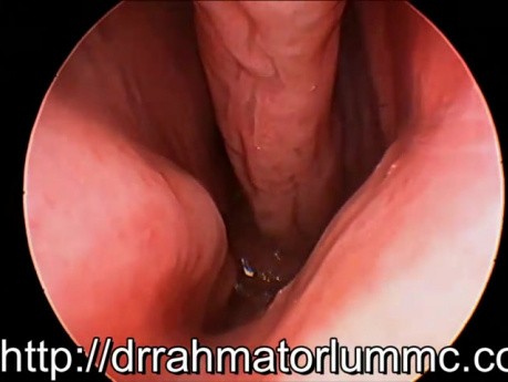 Inverted Papilloma