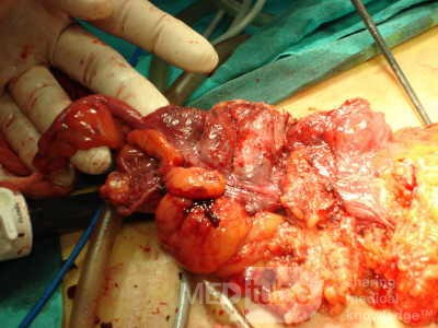 Severe case of Ischemic Colitis (12 of 19)