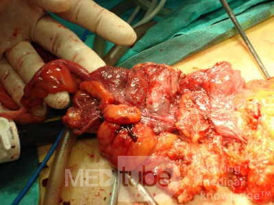 Severe case of Ischemic Colitis (12 of 19)