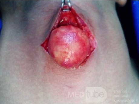 Neck Lipoma