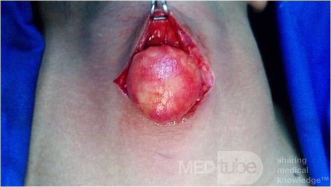Neck Lipoma