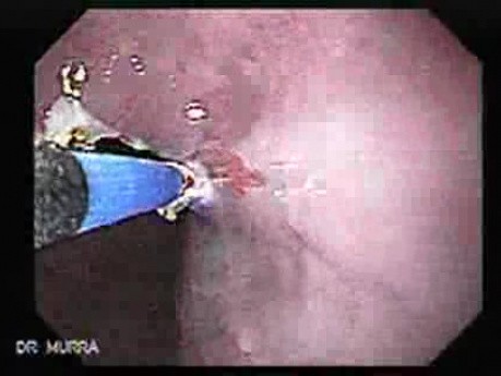 Barrett's Esophagus of long segment - ablation (6 of 11)