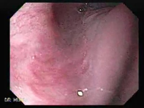 Esophageal Squamous Cell Carcinoma (1 of 3 )