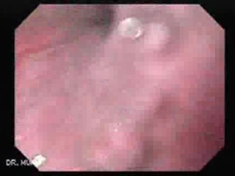 Esophagel Varices and Status Post Total Gastrectomy - 63 Years-Old Men