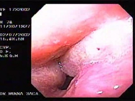 Laryngeal carcinom - extensive form in endoscopic imagination