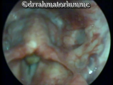 Intubation Granuloma involving the right arytenoid area