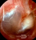 Congenital Epidermal Cyst Middle Ear