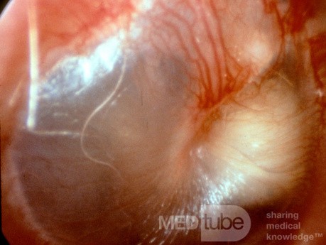 Congenital Epidermal Cyst Middle Ear