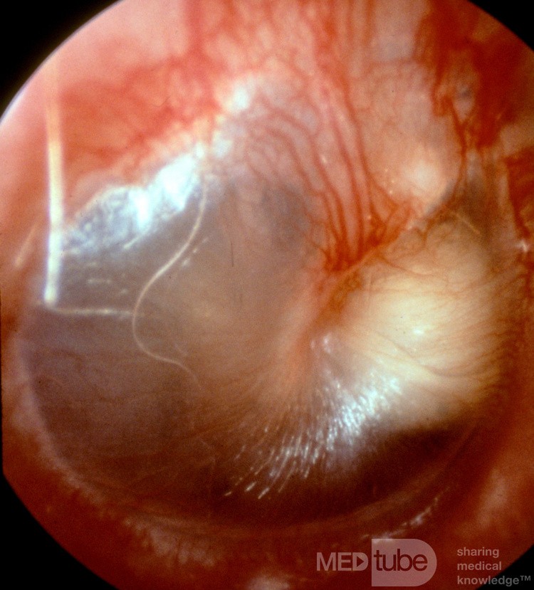 Congenital Epidermal Cyst Middle Ear