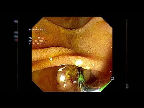 CBD Stone Extraction