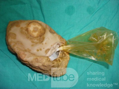Intragastric Balloon Deteriorotated By Gastric Acid (2 of 3)