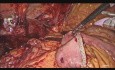 Laparoscopic Hepaticojejunostomy for Iatrogenic Bile Duct Injury.