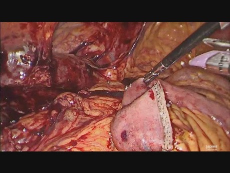 Laparoscopic Hepaticojejunostomy for Iatrogenic Bile Duct Injury.