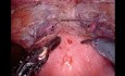 Robot-assisted Radical Cystectomy (RARC) and Intracorporeal Orthotopic Neobladder