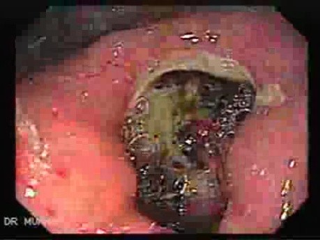 Duodenal Ulcer (3 of 5)