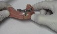 Implant Bar Overdenture - Model Demonstration
