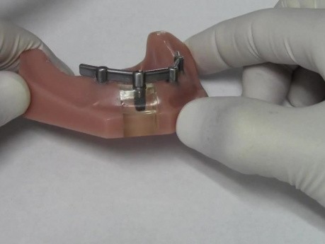 Implant Bar Overdenture - Model Demonstration