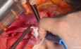  Liver Metastasis Resection Complicated by Right Hepatic Vein Injury: Control and Repair