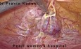 Laproscopic Scar Ectopic Pregnancy Removal