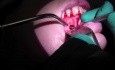 Root Canal Surgery (Apicoectomy #10) Part 2/2