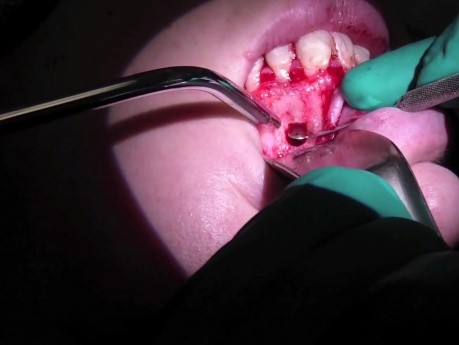 Root Canal Surgery (Apicoectomy #10) Part 2/2