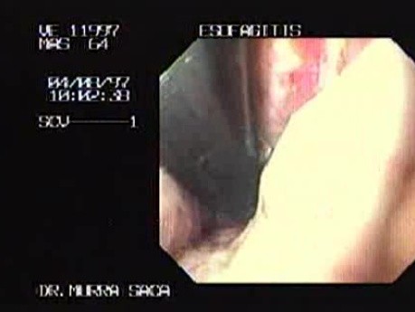Severe Esophagitis - Cardia Ulceration