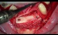 Bone Augmentation in Extreme Atrophic Lower Jaw