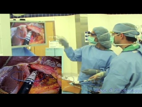 Resident Education with Laparo-Endoscopic Single Site (LESS) Toupet Fundoplication