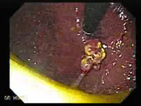 Ulcerated Hyperplastic Polyp (1 of 4)