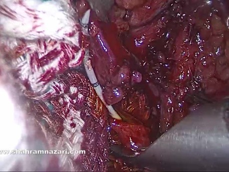 Cystic Duct Stump Measurement