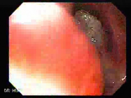 Egzophytic squamous cell carcinoma of the larynx - 2/3