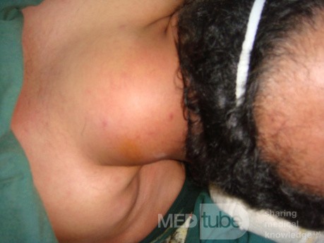 Lipoma in the posterior aspect of the neck