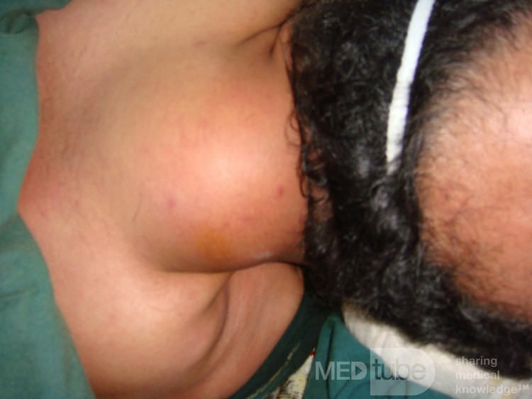 Lipoma in the posterior aspect of the neck