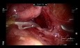 Robot Assisted Surgery for Ectopic Ureter in a 4 Year Old