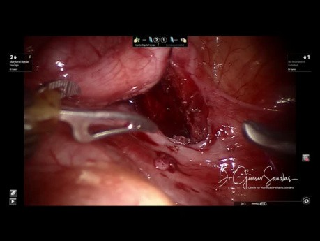 Robot Assisted Surgery for Ectopic Ureter in a 4 Year Old