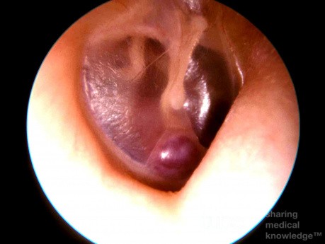 Dehiscent Carotid Artery
