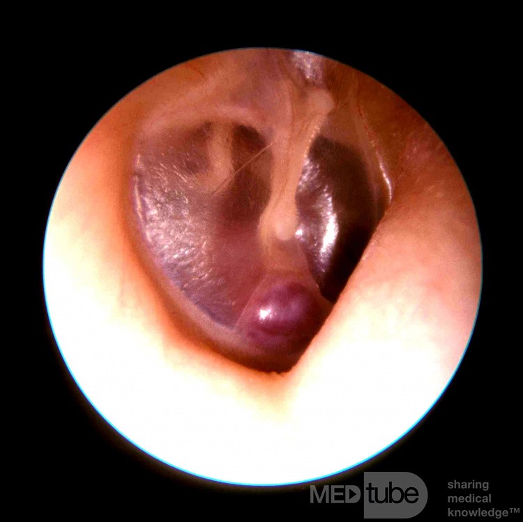Dehiscent Carotid Artery