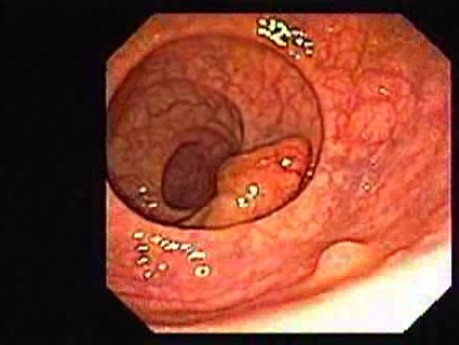 Tubulo-Villous Adenoma