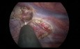 Bilateral Endoscopic Thoracic Sympathectomy for Primary Hyperhidrosis