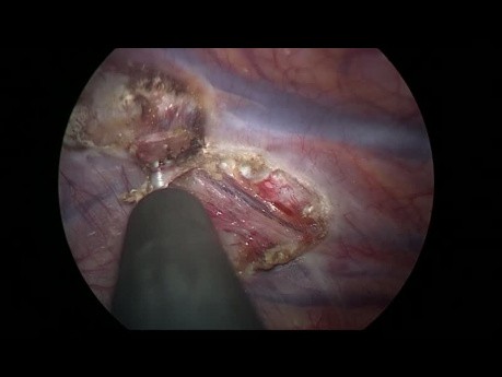 Bilateral Endoscopic Thoracic Sympathectomy for Primary Hyperhidrosis