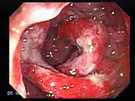 Multiple Adenomatous Polyps Of The Rectum (2 of 37)