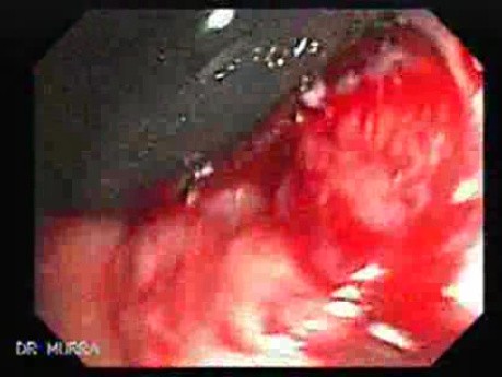 Familial Adenomatous Polyposis (23 of 36)