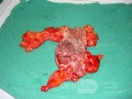 Severe case of Ischemic Colitis (15 of 19)