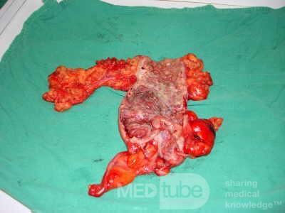 Severe case of Ischemic Colitis (15 of 19)